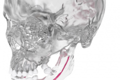MedCAD-AccuShape-Cranial-Implant-Brochure-14