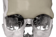 MedCAD-AccuShape-Cranial-Implant-Brochure-2