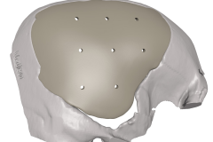 MedCAD-AccuShape-Cranial-Implant-Brochure-4
