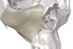 MedCAD-AccuShape-Cranial-Implant-Brochure-7