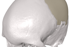 MedCAD-AccuShape-Cranial-Implant-Brochure-8