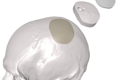MedCAD-AccuShape-Cranial-Implant-Brochure-9